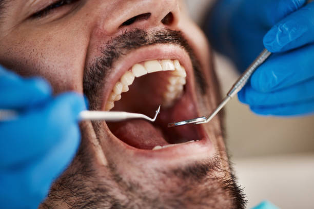 Best Emergency Wisdom Teeth Removal in Colonial Heights, TN
